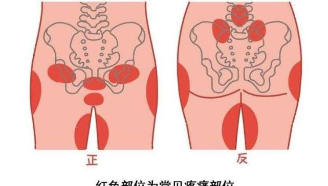 耻骨痛 到底是哪里痛 孕期有四类孕妇容易被它 找上门 耻骨联合 耻骨痛 孕妇 孕期