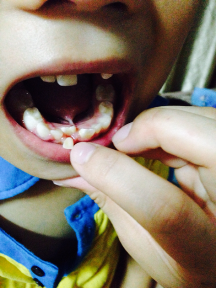 小朋友的乳牙在哪些情况下必须要拔除呢?_腾讯新闻