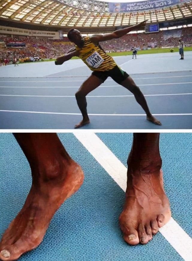 运动员有多刻苦?科比手指几乎全部变形,她曾为夺冠差点失去生命