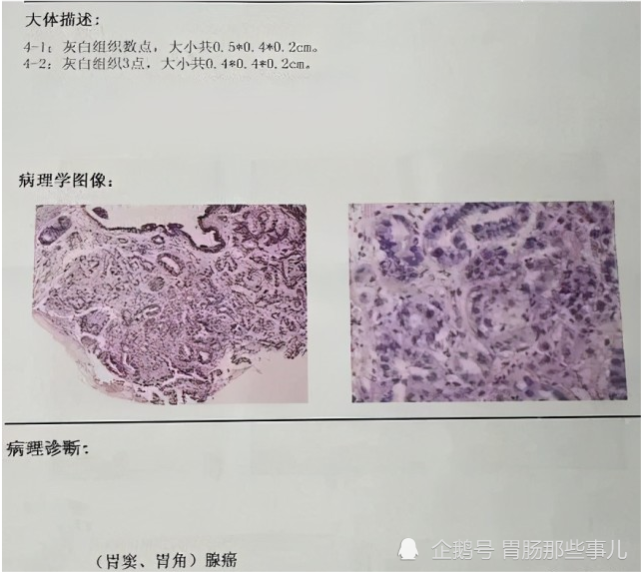 假如不是得了 带状疱疹 这个胃癌可能就 漏掉 了 腾讯网