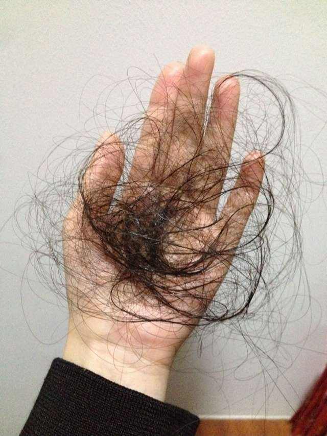 年轻人为什么会掉头发 腾讯新闻