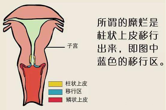 同的细胞,分别是子宫颈阴道部的鳞状上皮细胞和子宫颈管部的柱状上皮
