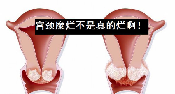 宫颈癌的早期症状是宫颈糜烂吗记住3点症状