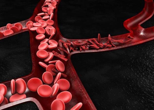 血栓|体内有血栓，睡觉时会有4种表现，当心血管可能正在变窄