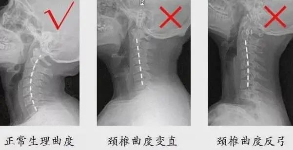 頸椎生理曲度變直怎麼辦