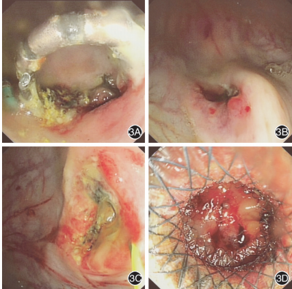 内镜观察胃内磁环;3b:取出磁环后胃内观察胃肠吻合口;3c:导丝越过吻合