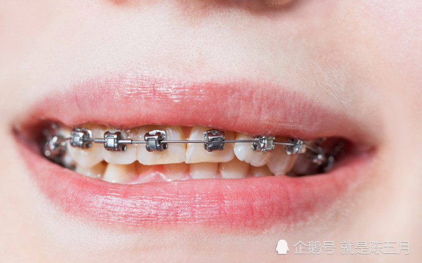 而是否需要拔牙,医生会通过如:咀嚼情况,外观,并结合口腔ct,模型分析