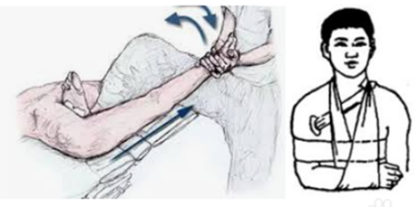 最常采用的手法复位是足蹬法(hippocrate 法):患者仰卧,术者位于患侧
