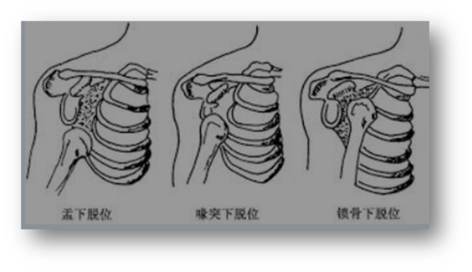 肩膀疼一个动作自测是否有肩关节脱位