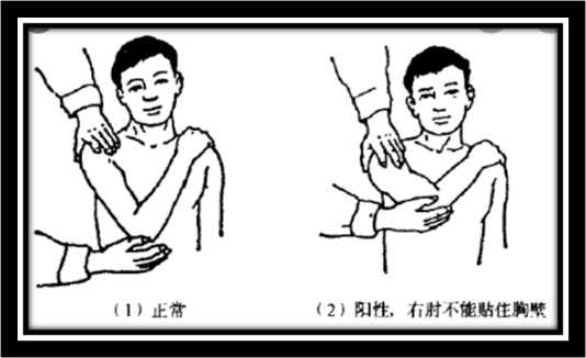 搭肩试验:又称杜加(dugas)试验,是指患者坐位或站立位,肘关节取屈曲位