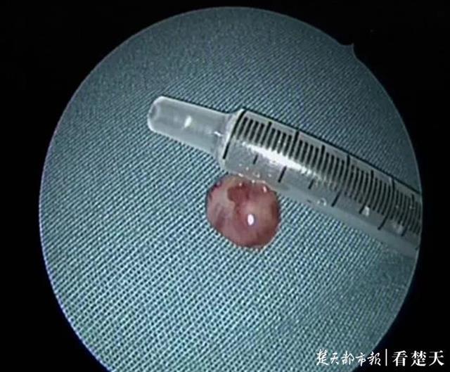 中年女子流泪三年,泪管里竟长出了息肉