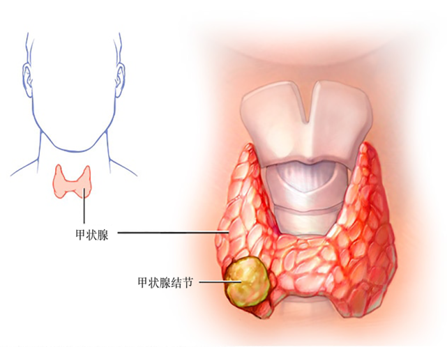七个问答,全面了解甲状腺结节