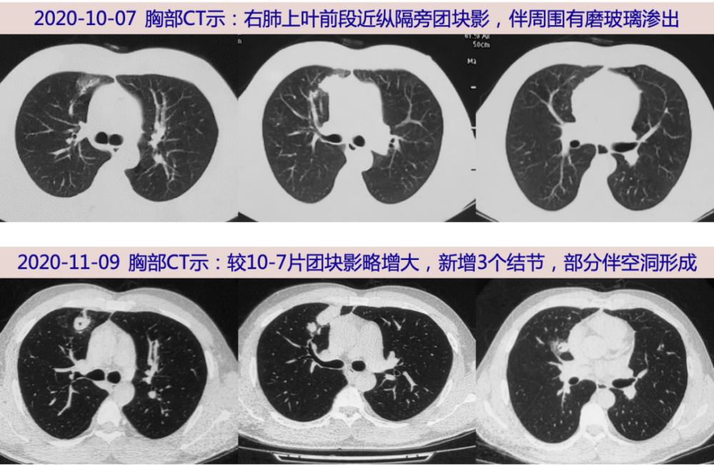 探案丨青年男性胸痛三月 Pet Ct显示肺结节和淋巴肿 腾讯新闻