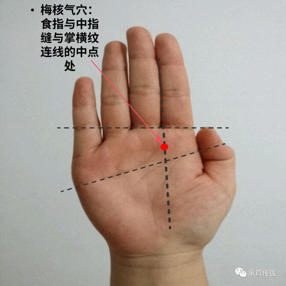 梅核气针灸三取穴:足三里.