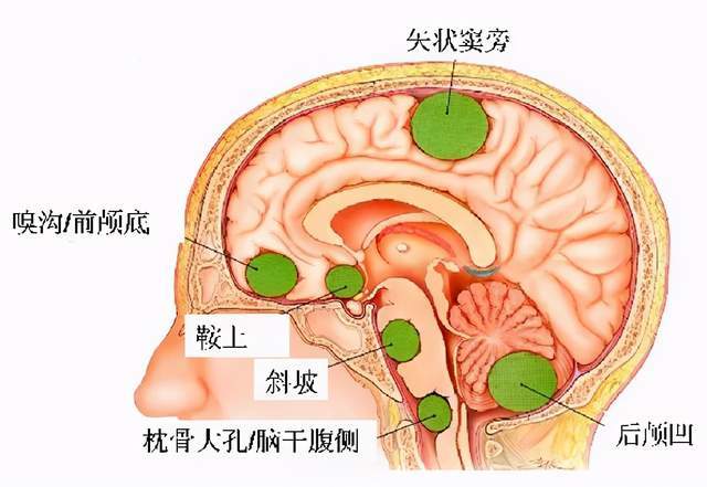 如何鉴别嗅沟脑膜瘤和鼻炎?