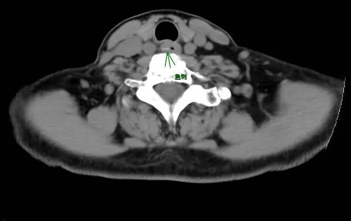 ct检查提示:c6-7水平食管内见线状高密度,长度约3cm,似见穿透外膜,与