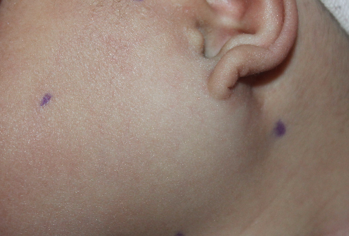 儿童腮腺瘤早期图片图片