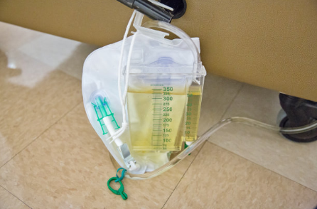 马尾神经损伤患者导尿注意事项