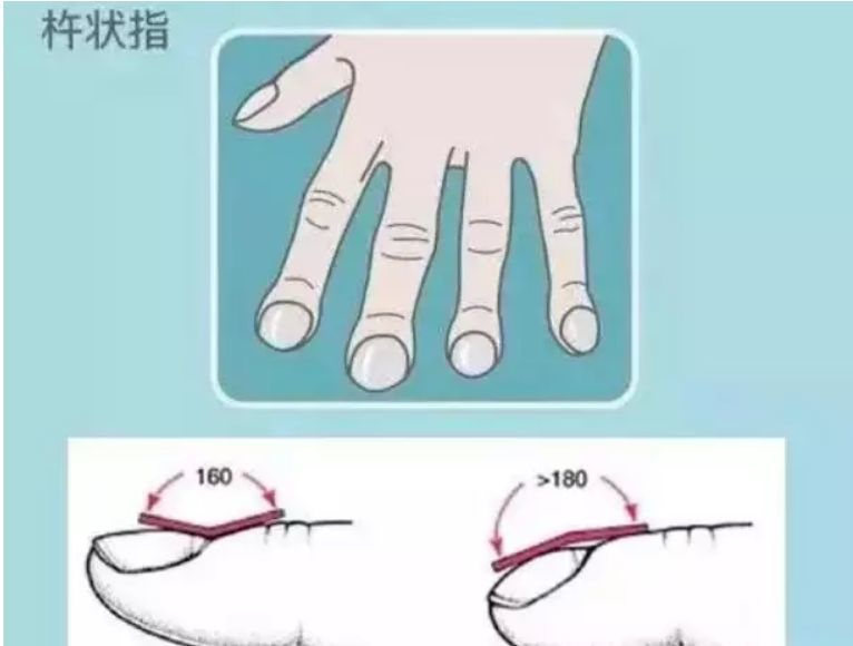 肺部|肺不好，会出现“1粗、2痛、3多”，占一个，也最好去查肺CT