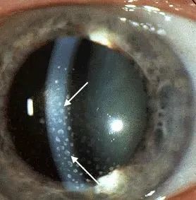 kp全称是角膜后沉着物,是眼内炎症的表现,也是虹膜炎的主要特征之一.