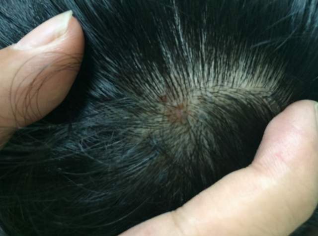 为什么头皮总长 疙瘩 和 脓包 医生 或许和3种疾病有关 腾讯网