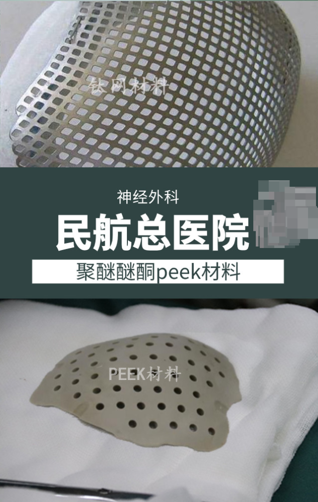 钛板修补颅骨怎么样