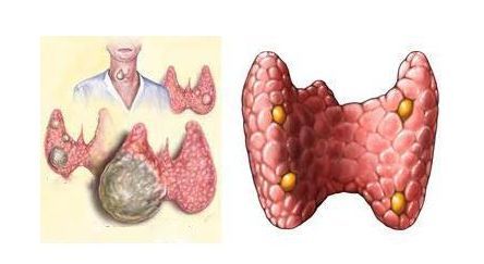 甲狀腺結節不重視,後果居然這麼嚴重?