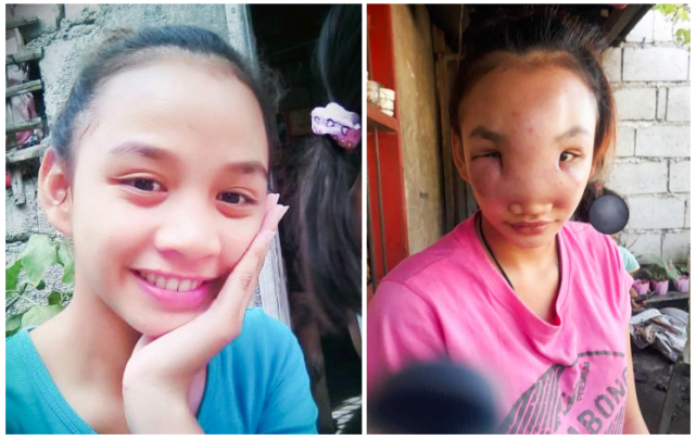 都是痘痘惹的祸菲律宾少女患上怪病双眼近乎失明面目全非