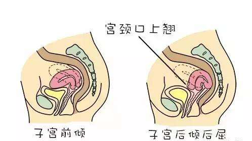 子宫前后位会影响怀孕吗?