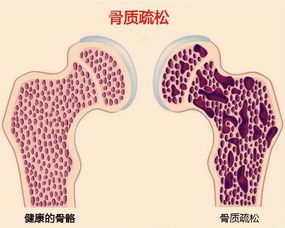 骨质疏松的人 不仅要少吃咸菜 这4件事也不能忽略了 腾讯网