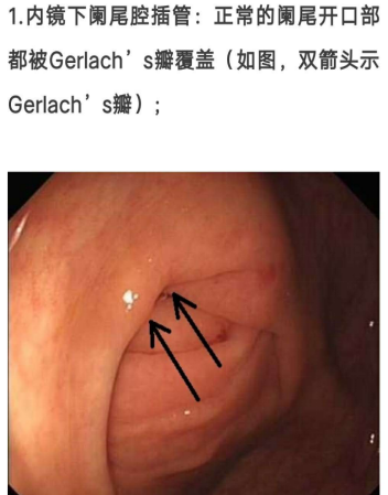 結腸鏡下治療急性闌尾炎初探