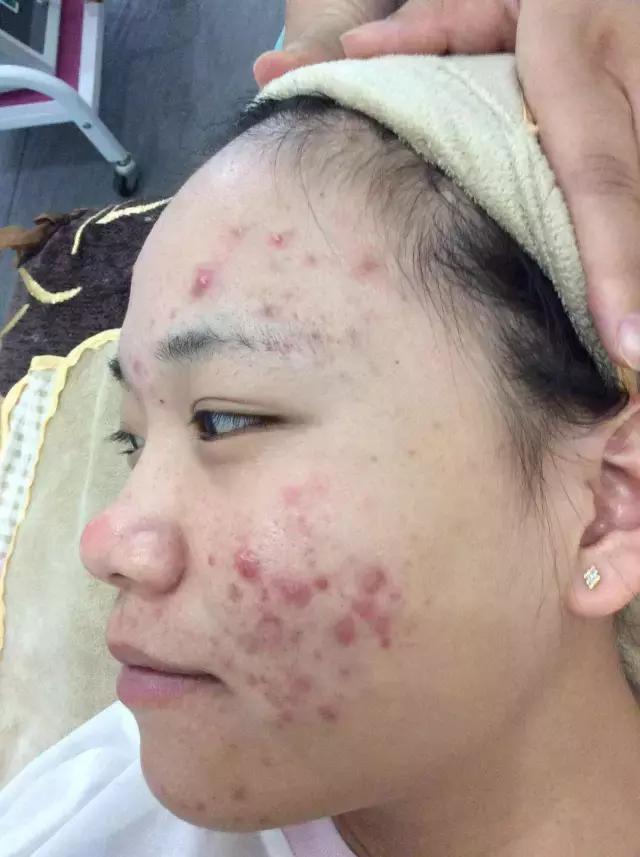 痘痘脸 腾讯网