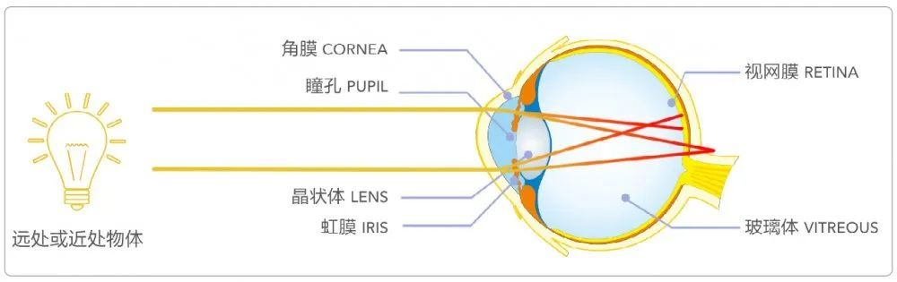 散光到底是怎么回事?能治好吗?一次给您说清楚!