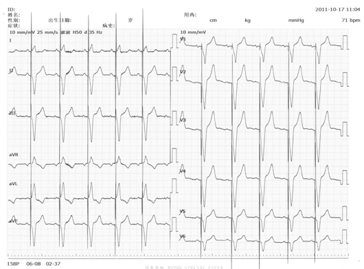 總之,當就診患者檢查心電圖時發現異常q波不僅要排除人為干擾因素