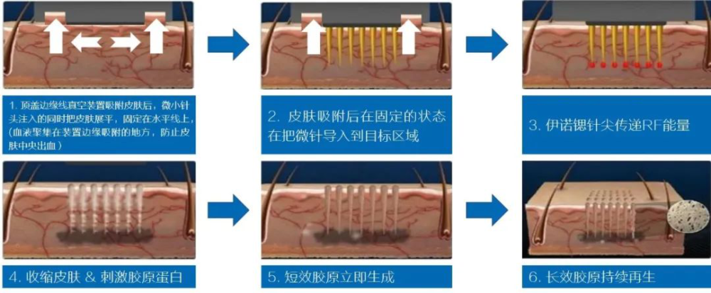 郭晓瑞:"无胶原不年轻"——射频微针与皮肤年轻化丨科普篇_腾讯新闻