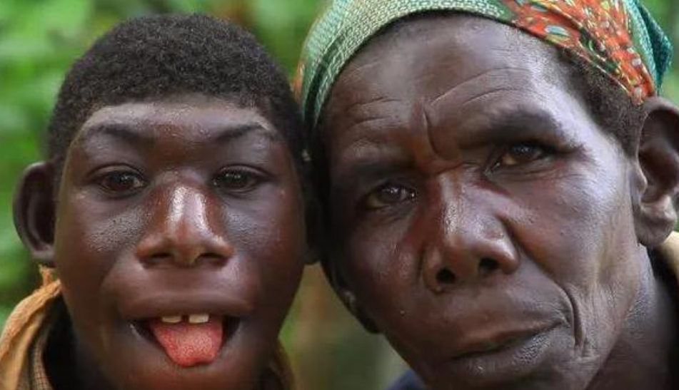 艾力和其他的小朋友有点不同,他患上了小头畸形,他的脑袋,比周围的