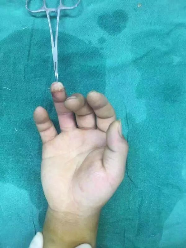 病人是被冲床压伤完全穿透手指,手术恢复如初_腾讯新闻