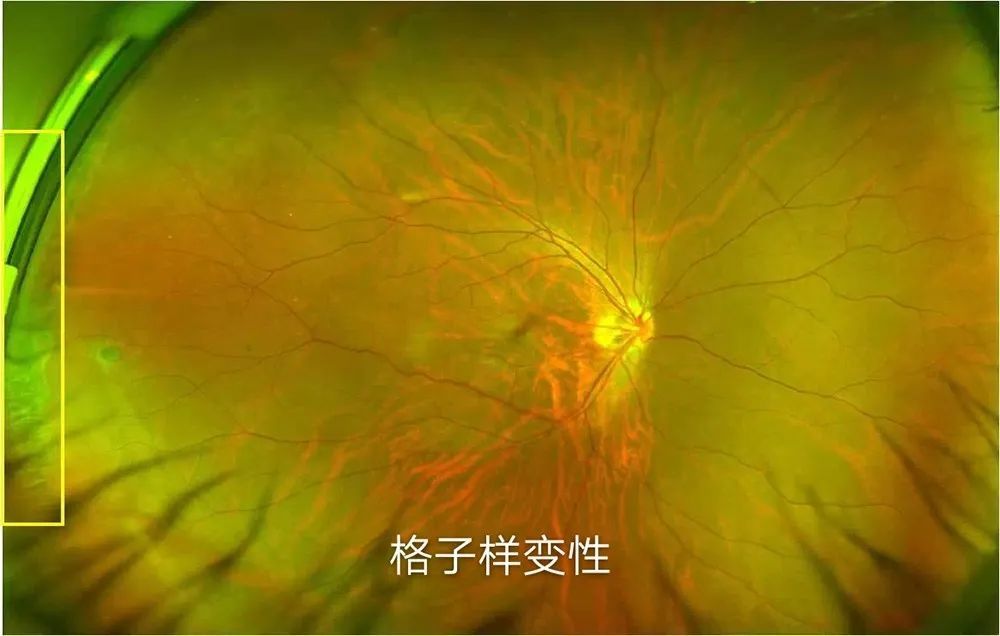 视网膜格子样变性照片图片