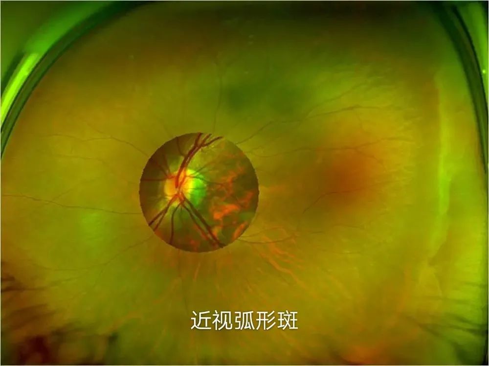 孩子刚上小学近视就超过600度了怎么办