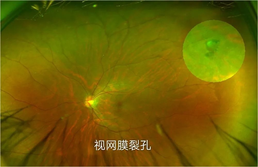 近视增长快,屈光度每年增长超过100度;眼b超提示眼球后巩膜葡萄肿