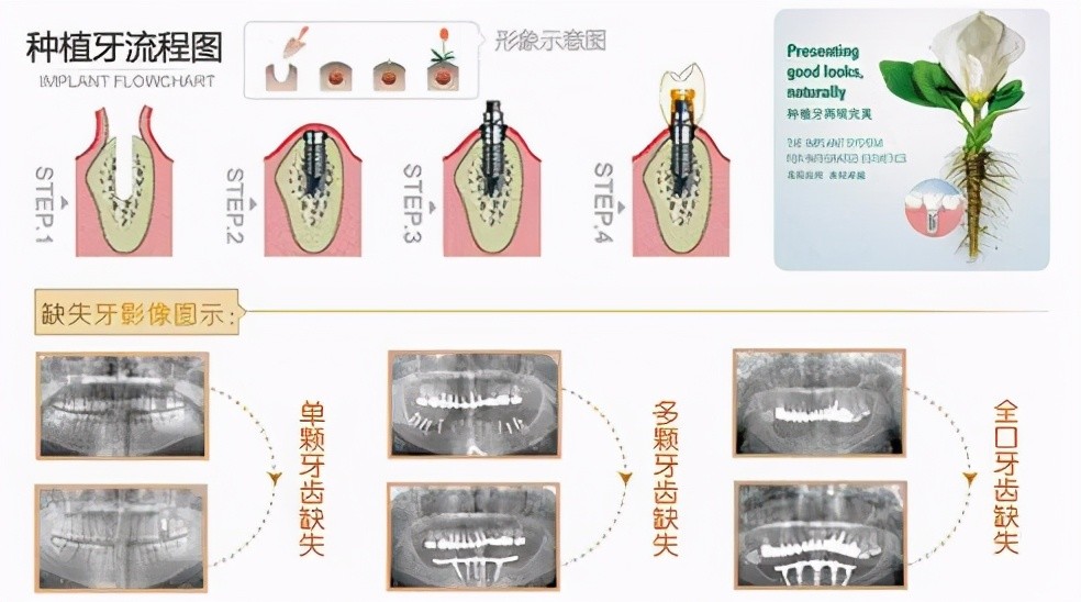 5,安装愈合基台.使种植体穿出牙龈,等待软组织成形.