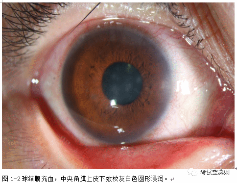眼科临床案例 流行性角结膜炎 腾讯新闻