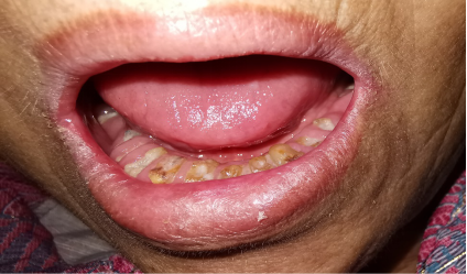 什么是干燥综合征?