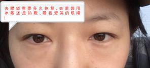 去眼袋需要多久恢复 去眼袋用冰敷还是热敷 看我爱笑的眼睛 腾讯新闻