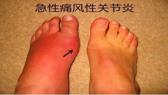 痛风会引发这么多疾病,你真的了解痛风吗?