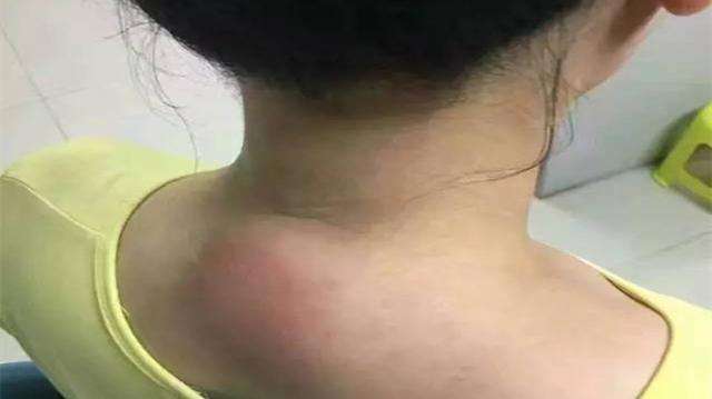 颈后的这种大包虽叫富贵包但很危险早知道早预防