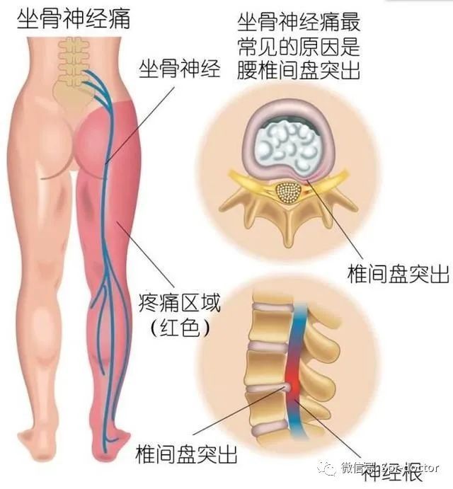 引起坐骨神经痛的原因有哪些坐骨神经痛的治疗方法 脊椎 坐骨神经痛 椎间盘突出症 下背痛 腰椎