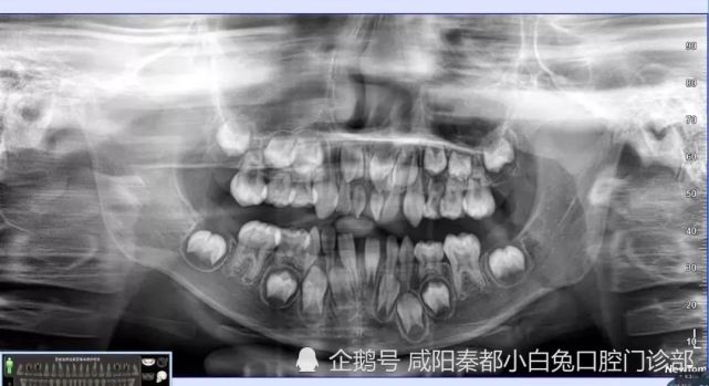 為啥看個牙非讓我去拍牙片呢?