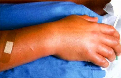 日本核辐射有多可怕他看着自己的皮肤一点点脱落成为一具活尸