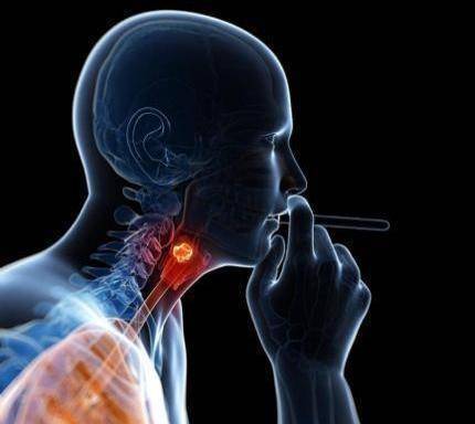 年轻女性发现喉癌 竞和这个因素有关_腾讯新闻